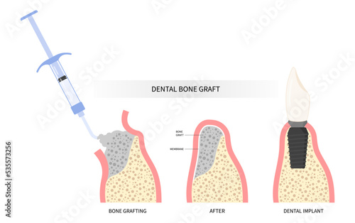 Procedure of Teeth bone Graft surgery photo