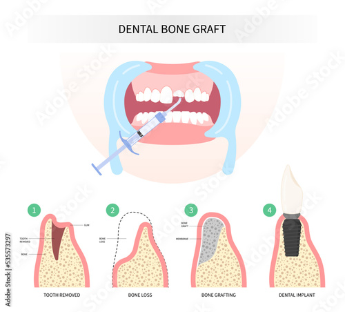 extraction Procedure of Teeth bone Graft surgery
