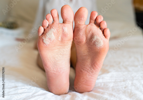Problems with the skin of the feet. Dermatological diseases. Close-up.
