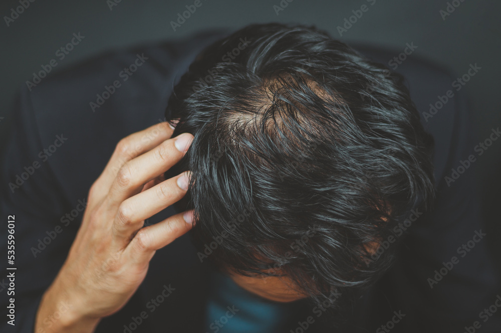 Naklejka premium Men have problems with hair loss, thinning hair, baldness