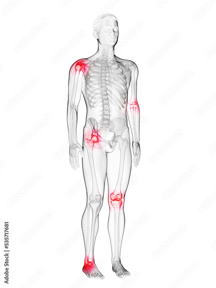 3d rendered medically accurate illustration of a mans painful joints