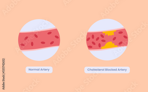 Good and bad cholesterol in our body. health and medical concept. vector illustration.