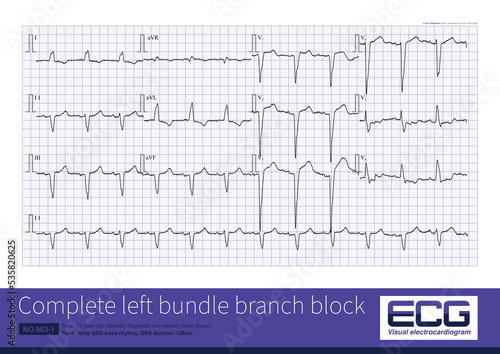 In complete left bundle branch block, the QRS wave in lead V1 is usually in rS and QS morphologies, with QRS duration ≥ 120ms, which is common in organic heart disease. photo