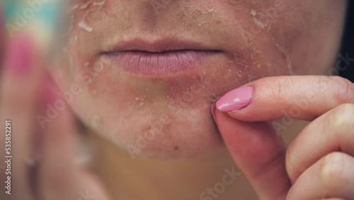 Close up 4k video of woman touching her face as she has skin problems.
