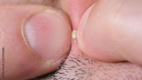 Macro video, squeezing a white pimple from the face.  photo