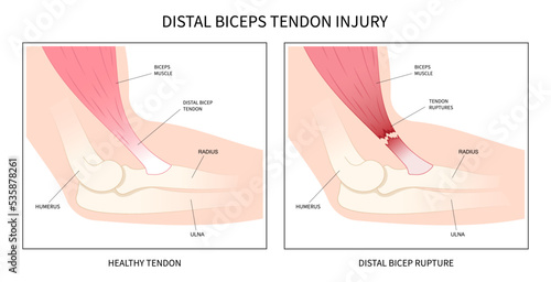 Fotografering distal bicep tendonitis rotator cuff pain upper arm inflamed