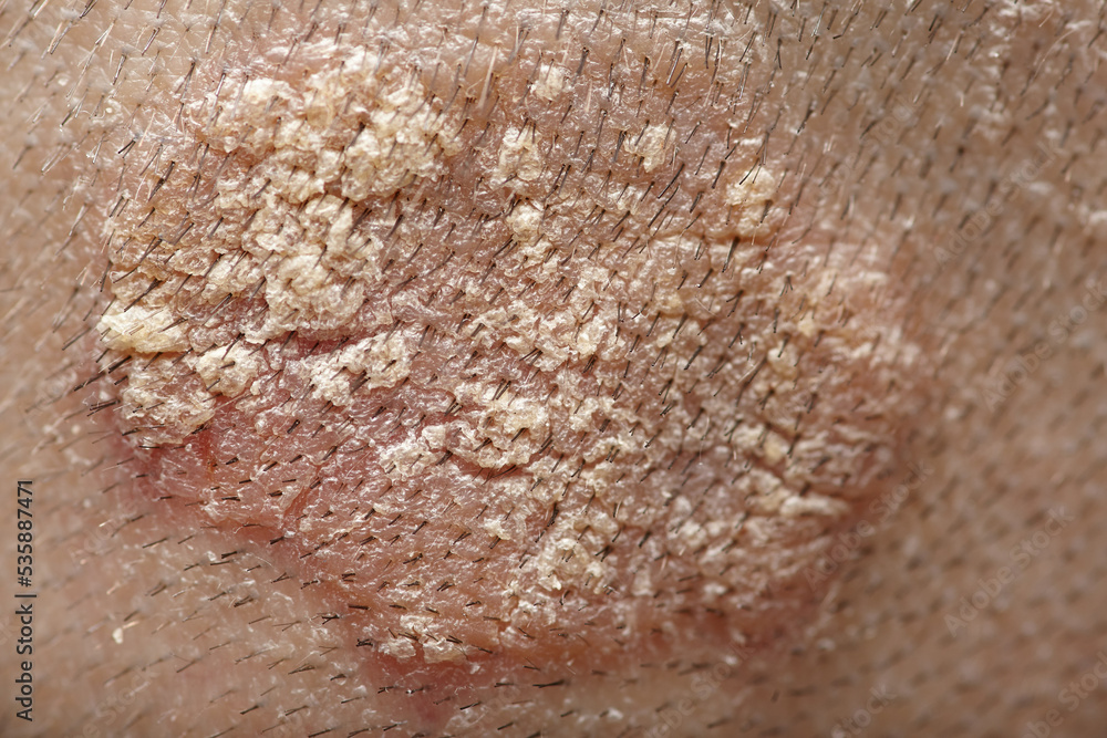 Fototapeta premium Eczema caucasian male head back