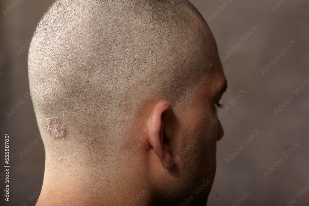 Naklejka premium Eczema caucasian male head back