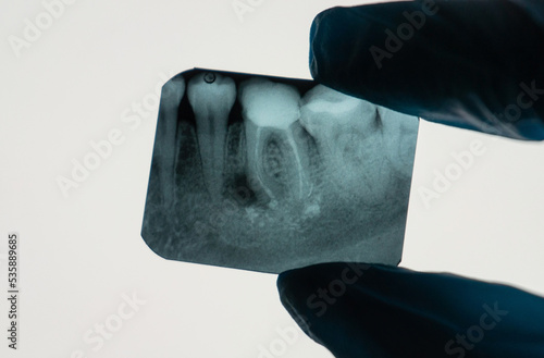Dental Periapical Granuloma next to tooth root on an X-ray held by a Dentist