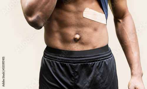 Картината върху платно Close up: African American adult man navel with Umbilical hernia, a defect of the abdominal wall near the belly button (umbilicus) on white beige background