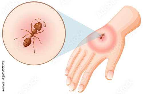 Ant bites sting on skin