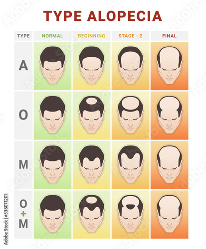 Hair loss stages infographic medical education scheme vector flat baldness types info chart