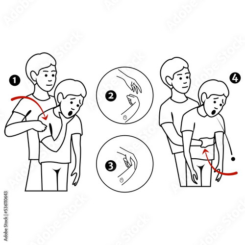 Heimlich's maneuver. First aid procedure for choking due to obstruction of the upper respiratory tract by foreign bodies. Vector flat illustration photo