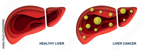 Liver cancer and healthy organ vector illustration