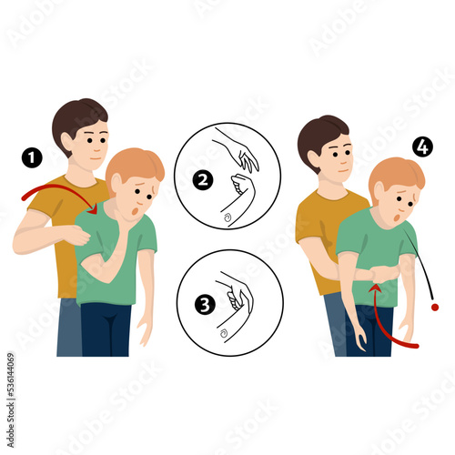 Heimlich's maneuver. First aid procedure for choking due to obstruction of the upper respiratory tract by foreign bodies. Vector flat illustration photo