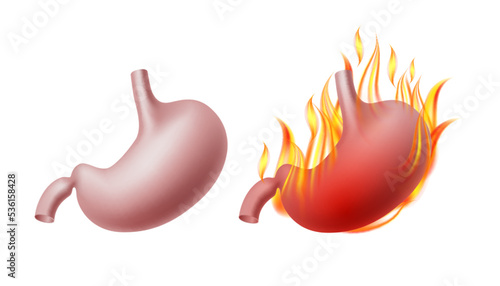 Healthy human stomach and Burning stomach. Vector illustration photo