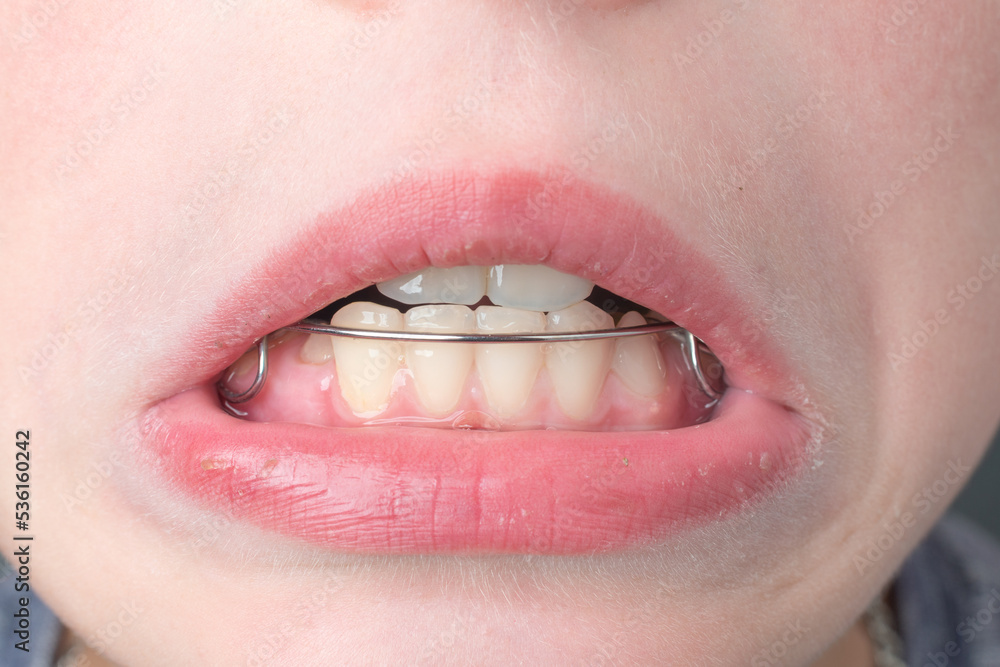 Obraz premium The boy wears a dental plate on his lower jaw.