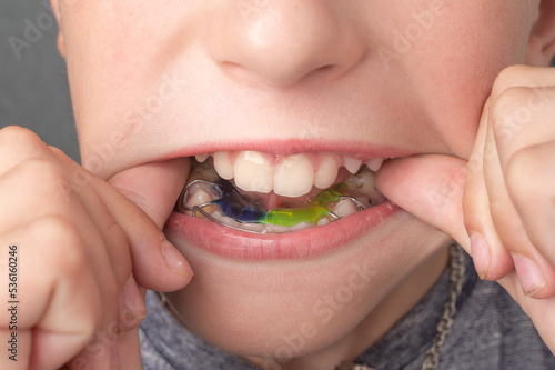 Mandibular plate, a boy wears a plate to align his teeth.