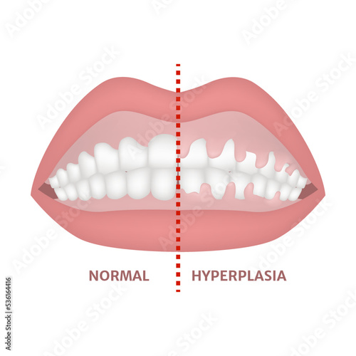 Gingival hyperplasia. Medical poster. Vector illustration