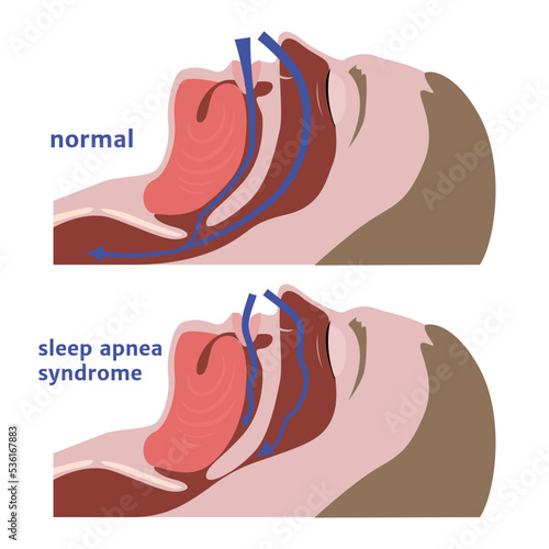 Sleep apnea. Respiratory tract diagram. Medical poster. Vector illustration