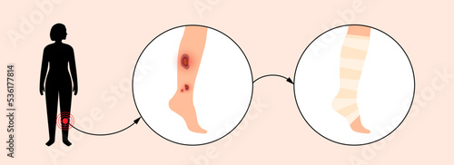 Human leg injury
