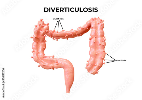 diverticulosis is a gastrointestinal disorder in which diverticula form in the intestine
