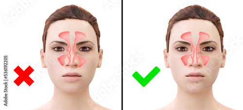Schilderij op canvas Woman before and after nasal septum deviation correction