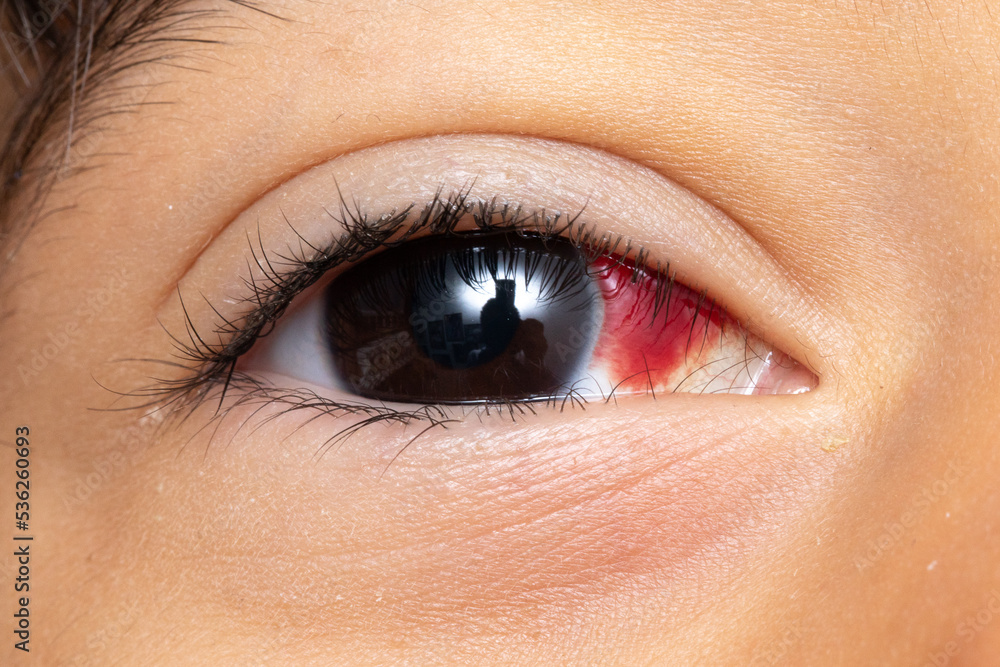 Macro of baby eye with subconjunctival hemorrhage Macro of baby eye with subconjunctival hemorrhage