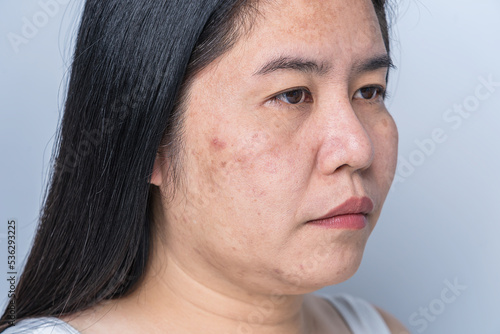 Фототапет Asian adult woman face has freckles, large pores, blackhead pimple and scars problem from not take care for a long time