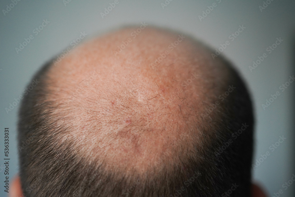 Bald head close-up. The problem of hair loss in men. Alopecia in men. Bald head close-up. The problem of hair loss in men. Alopecia in men.