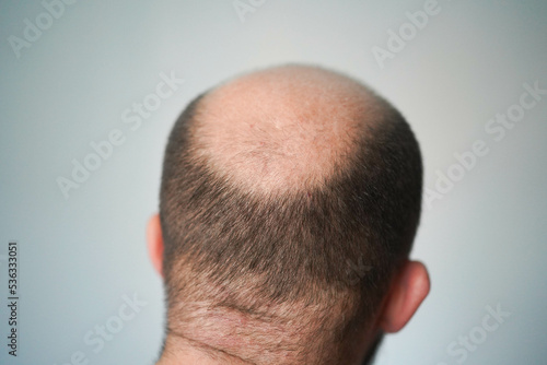 Bald head close-up. The problem of hair loss in men. Alopecia in men.