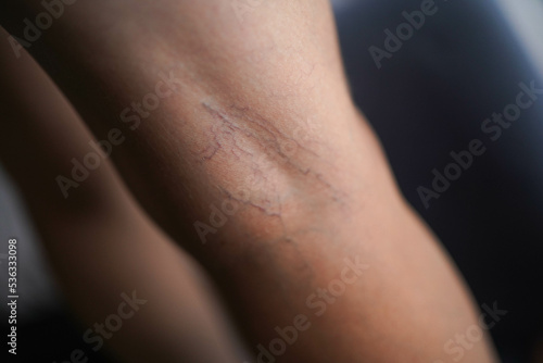 Vascular network on the human body. Telangiectasias on the skin. © Petro