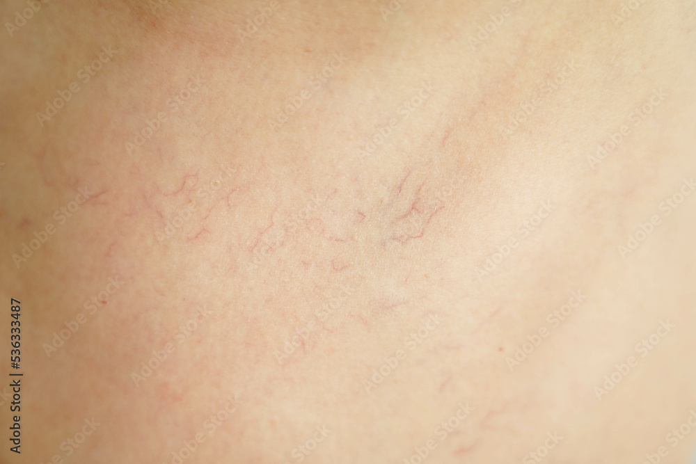 Fototapeta premium Vascular network on the human body. Telangiectasias on the skin.