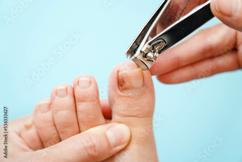 Close-up of problematic nails. Nail disease. The process of performing a pedicure with nail clippers.