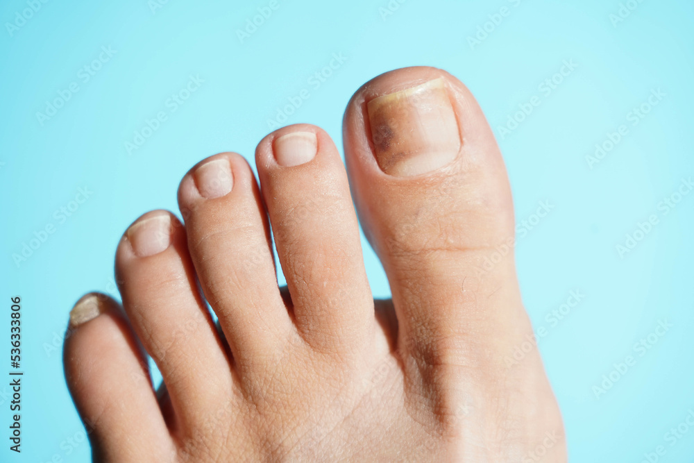 Problem nails close-up on a blue background. Nail disease. Problem nails close-up on a blue background. Nail disease.