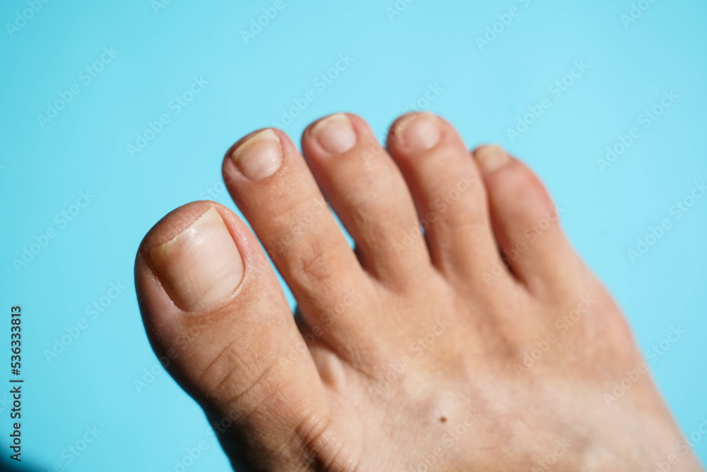 Problem nails close-up on a blue background. Nail disease. Problem nails close-up on a blue background. Nail disease.