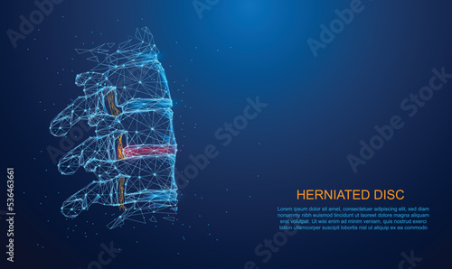 Herniated disk concept and spine pain diagnostic in low polygon, particle, and triangle style design.Wireframe light connection structure.