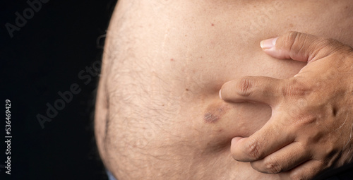 fat man is scratching his hands with his fingernails, inflamed and red parts of his body causing discomfort and itching. A man is suffering from bouts of purulent dermatitis. concept of skin disease