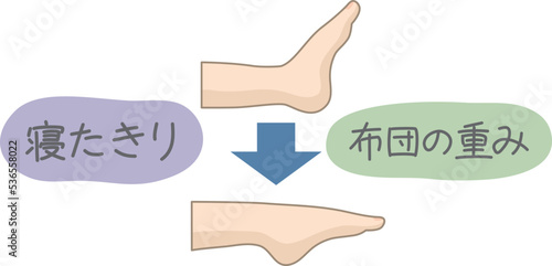 習慣性尖足の原因
