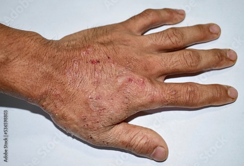 Photographie Itchy skin lesions in hand of Asian man