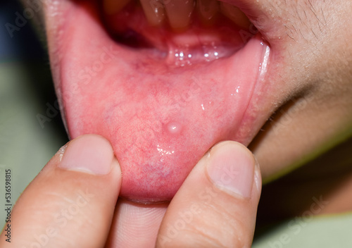 Small vesicle lesion at lower lip photo