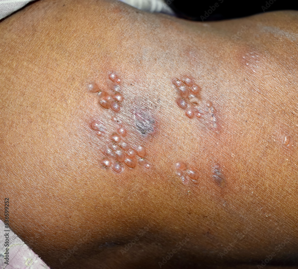 Herpes simplex infection at lower back. Small and painful vesicles. - obrazy, fototapety, plakaty 