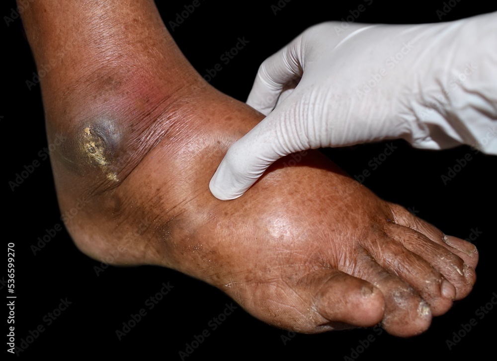 Fototapeta premium Pitting edema of lower limb. Swollen leg of Asian man.