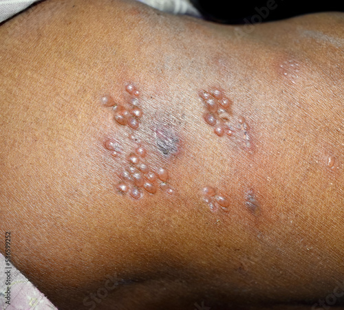 Herpes simplex infection at lower back. Small and painful vesicles.
