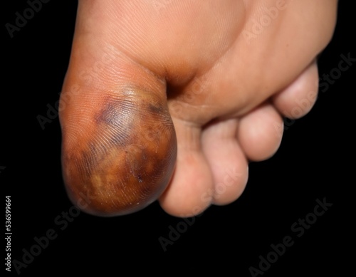 Abscess and cellulitis or Staphylococcal, Streptococcal skin infection at the big toe of Asian male patient.