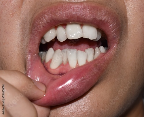 Stacked or overlapping white teeth. Also called crowded teeth.