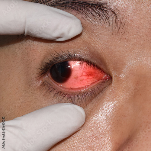 Corneal infection or ulcer called keratitis in Asian man. photo