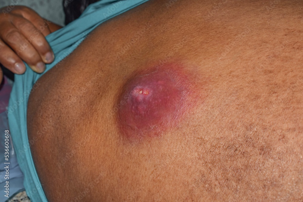 Fototapeta premium Large carbuncle or abscess at the back of Asian female patient.