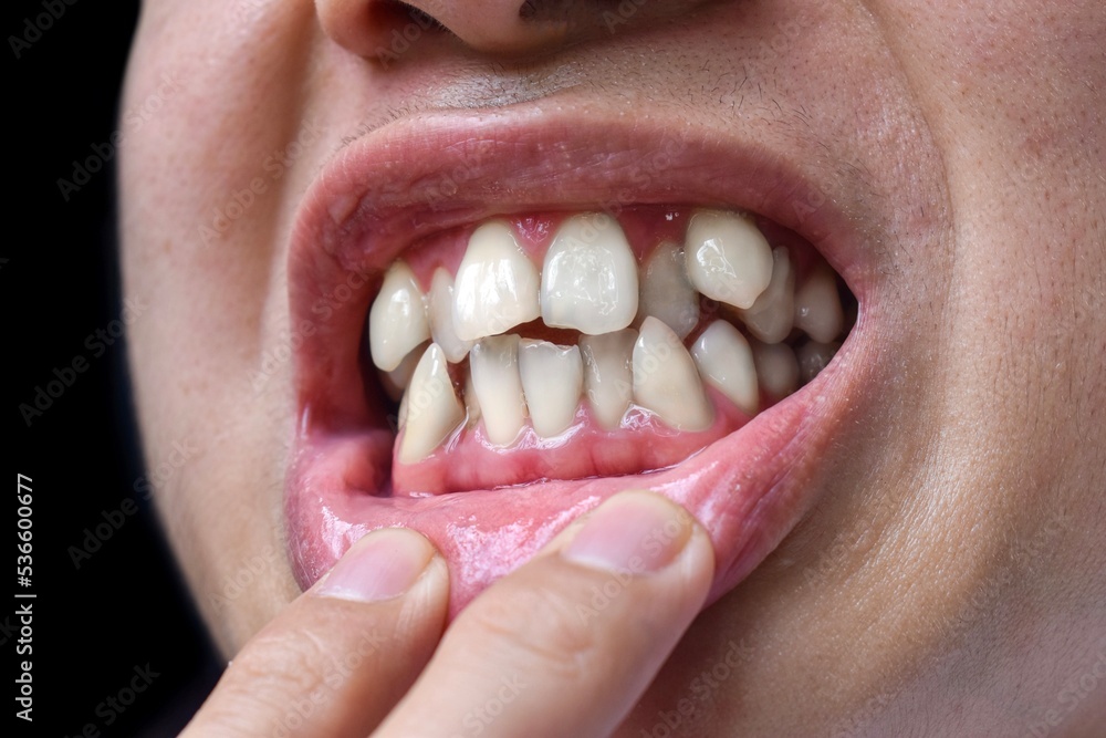 Obraz premium Stacked or overlapping white teeth. Also called crowded teeth.