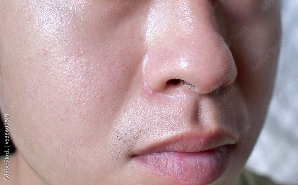 Fototapeta premium Fair skin with wide pores in oily face of Asian, Myanmar or Korean adult young man.